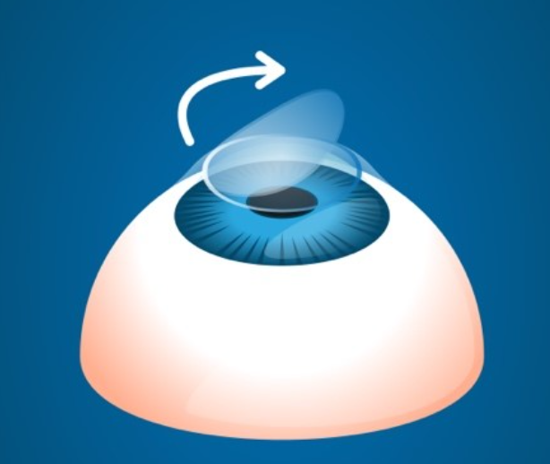 LASIK Jakarta: Solusi Modern Operasi LASIK untuk Mengurangi Ketergantungan pada Kacamata
